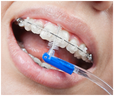 braces
