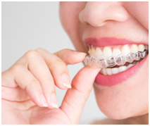 clear-aligners
