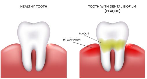 healthy-tooth